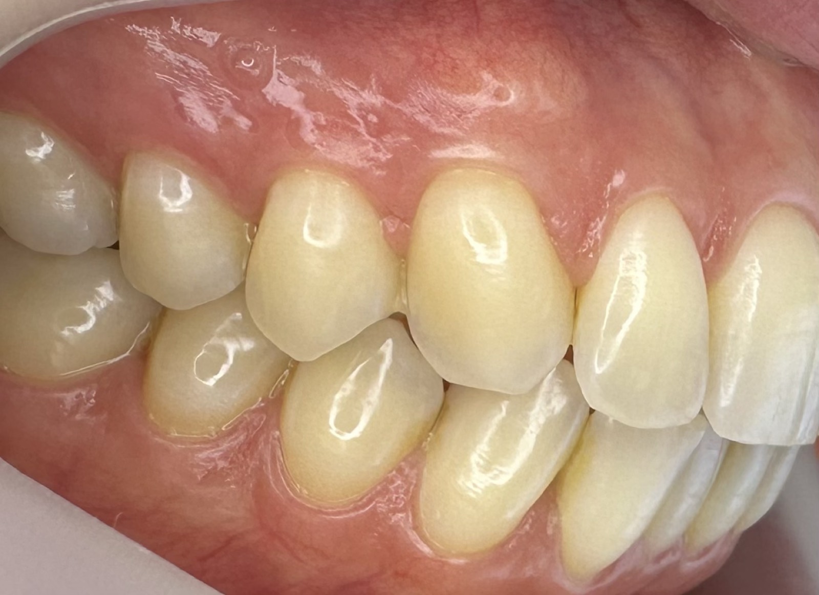 Casos clínicos 16 Injerto de encía, cirugía plástica periodontal, caso 1, después. Dra. Mercedes Iriarte, Belgrano.