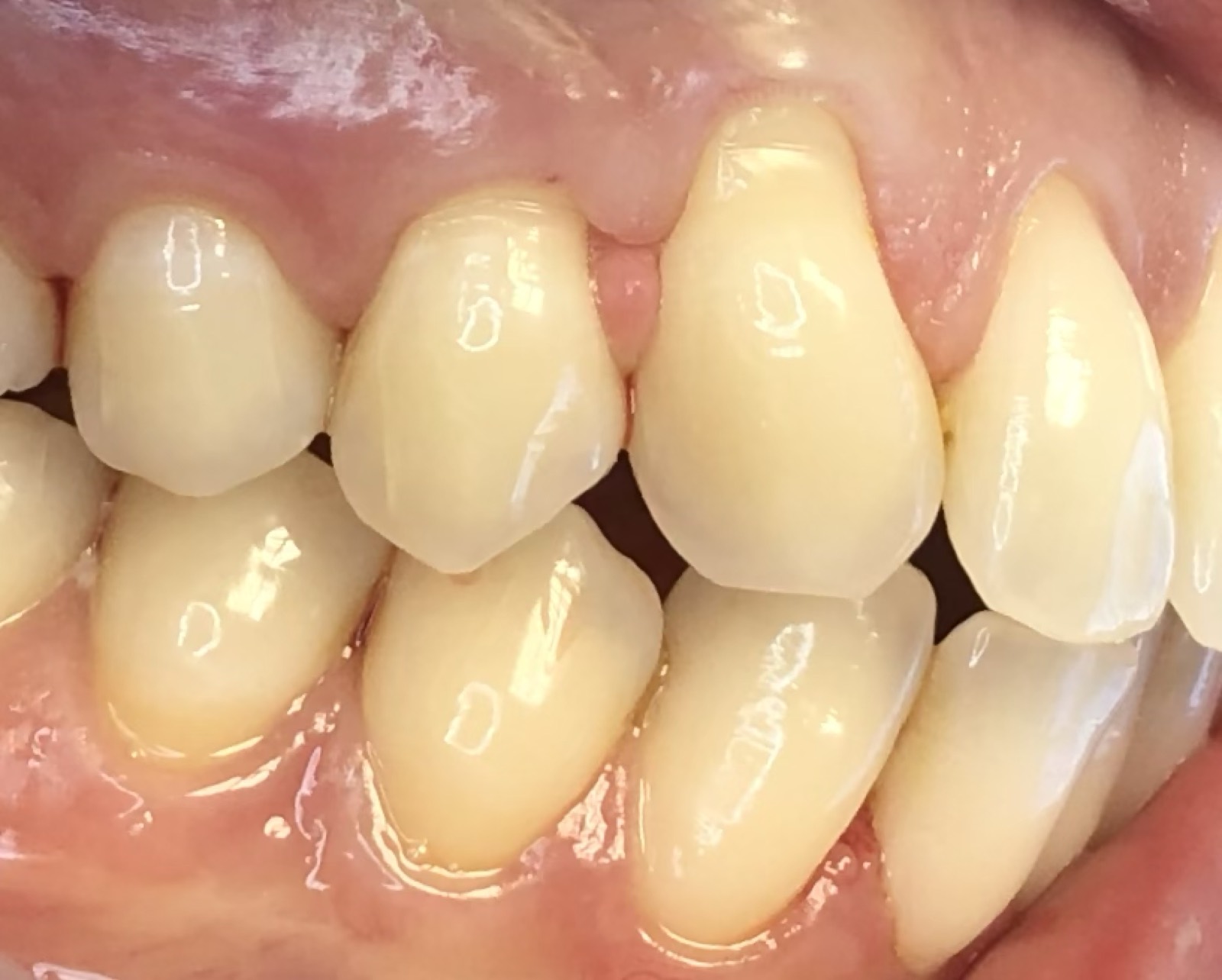 Casos clínicos 15 Injerto de encía, cirugía plástica periodontal, caso 1, antes. Dra. Mercedes Iriarte, Belgrano.