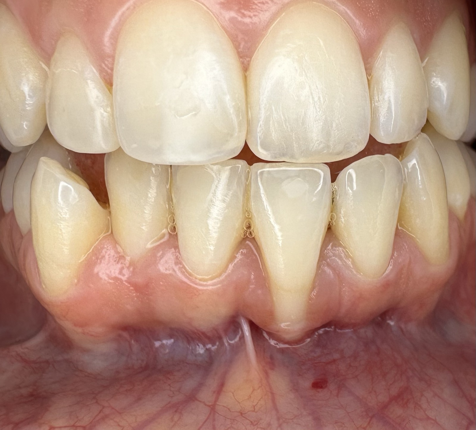 Casos clínicos 17 Injerto de encía, cirugía plástica periodontal, caso 2, antes. Dra. Mercedes Iriarte, Belgrano.