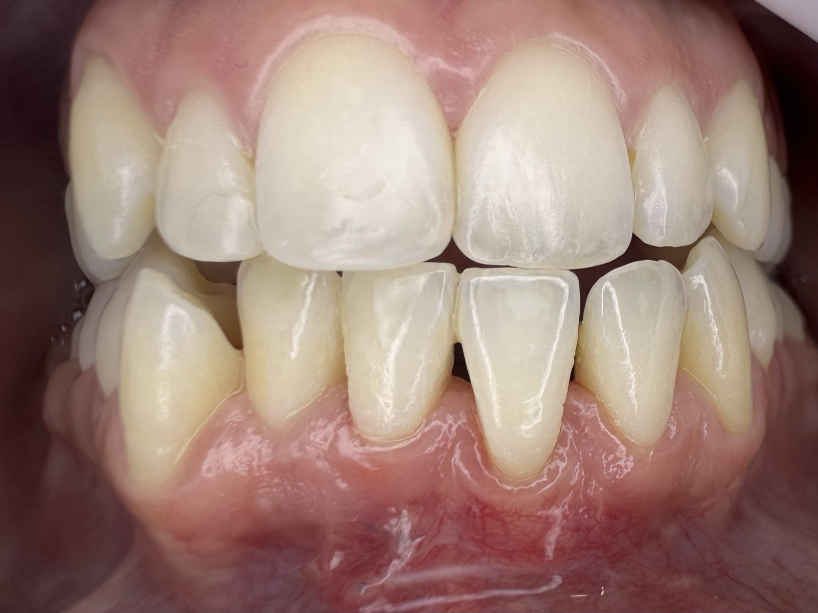 Casos clínicos 18 Injerto de encía, cirugía plástica periodontal, caso 2, después. Dra. Mercedes Iriarte, Belgrano.