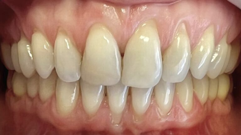 Inicio 5 Injerto de encía, cirugía plástica periodontal, caso 3. Dra. Mercedes Iriarte, Belgrano.