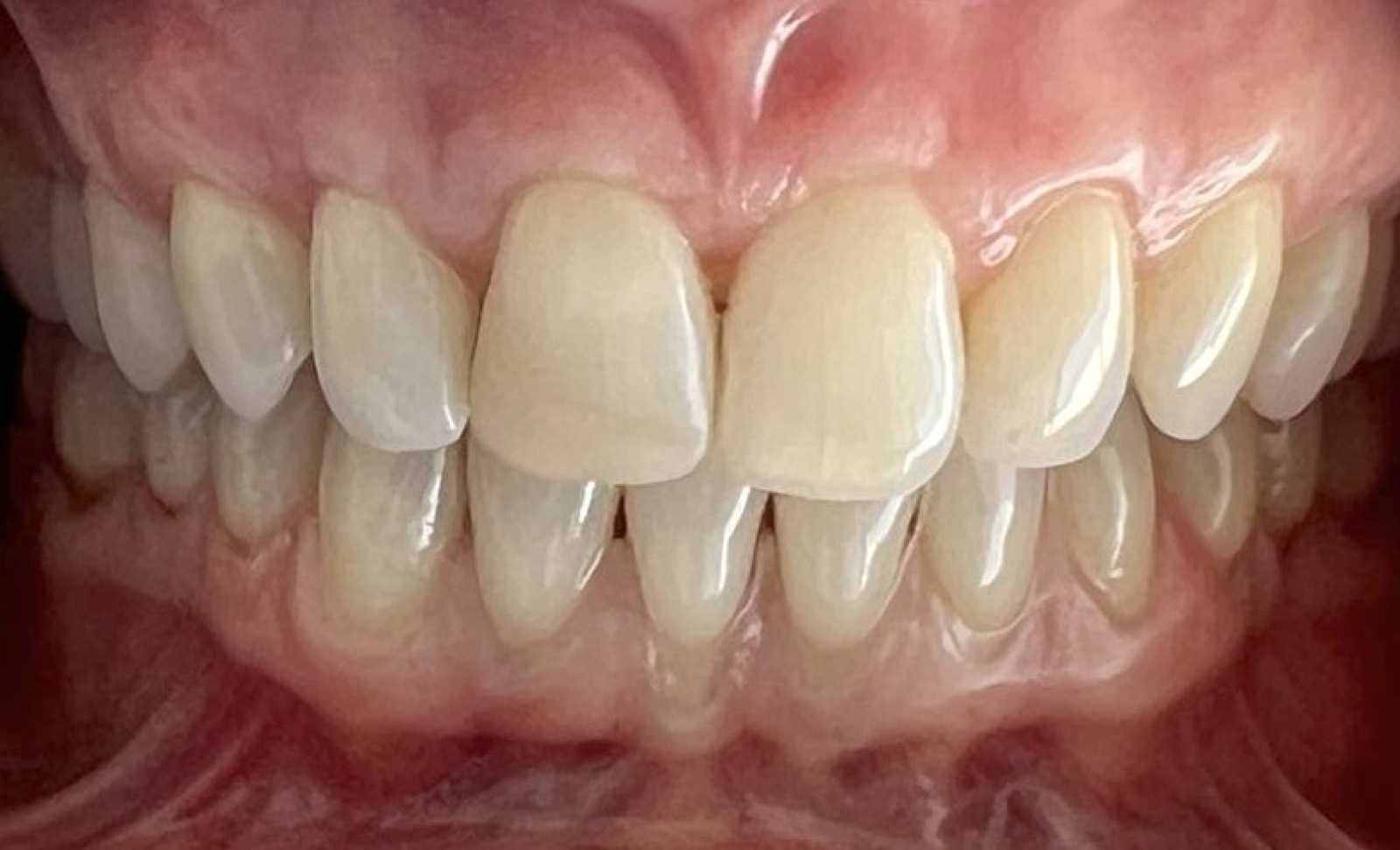 Casos clínicos 20 Injerto de encía, cirugía plástica periodontal, caso 3, después. Dra. Mercedes Iriarte, Belgrano.