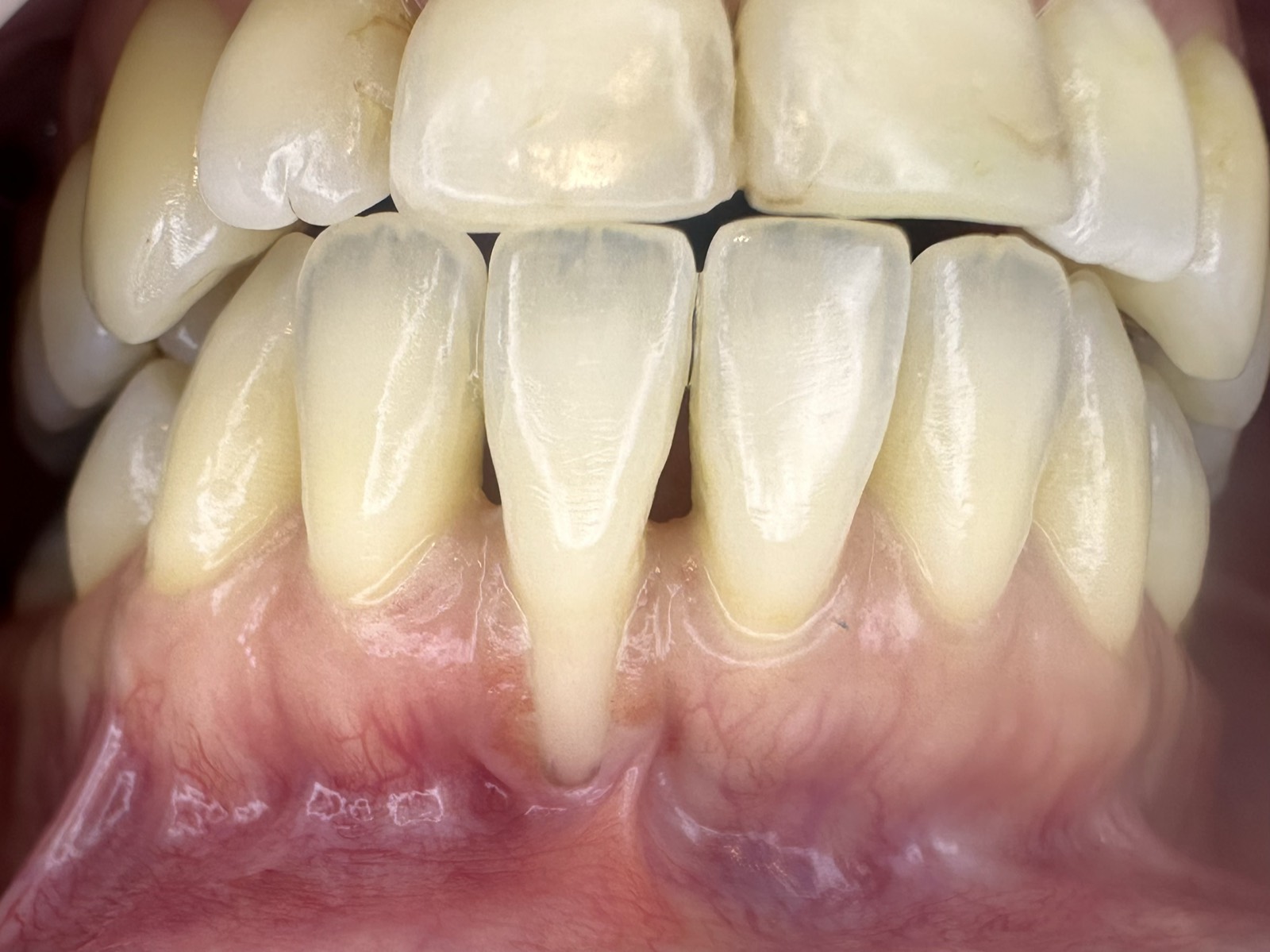 Casos clínicos 21 Injerto de encía, cirugía plástica periodontal, caso 4, antes. Dra. Mercedes Iriarte, Belgrano.