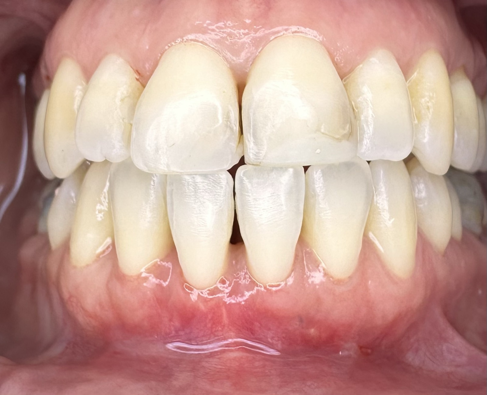 Casos clínicos 22 Injerto de encía, cirugía plástica periodontal, caso 4, después. Dra. Mercedes Iriarte, Belgrano.