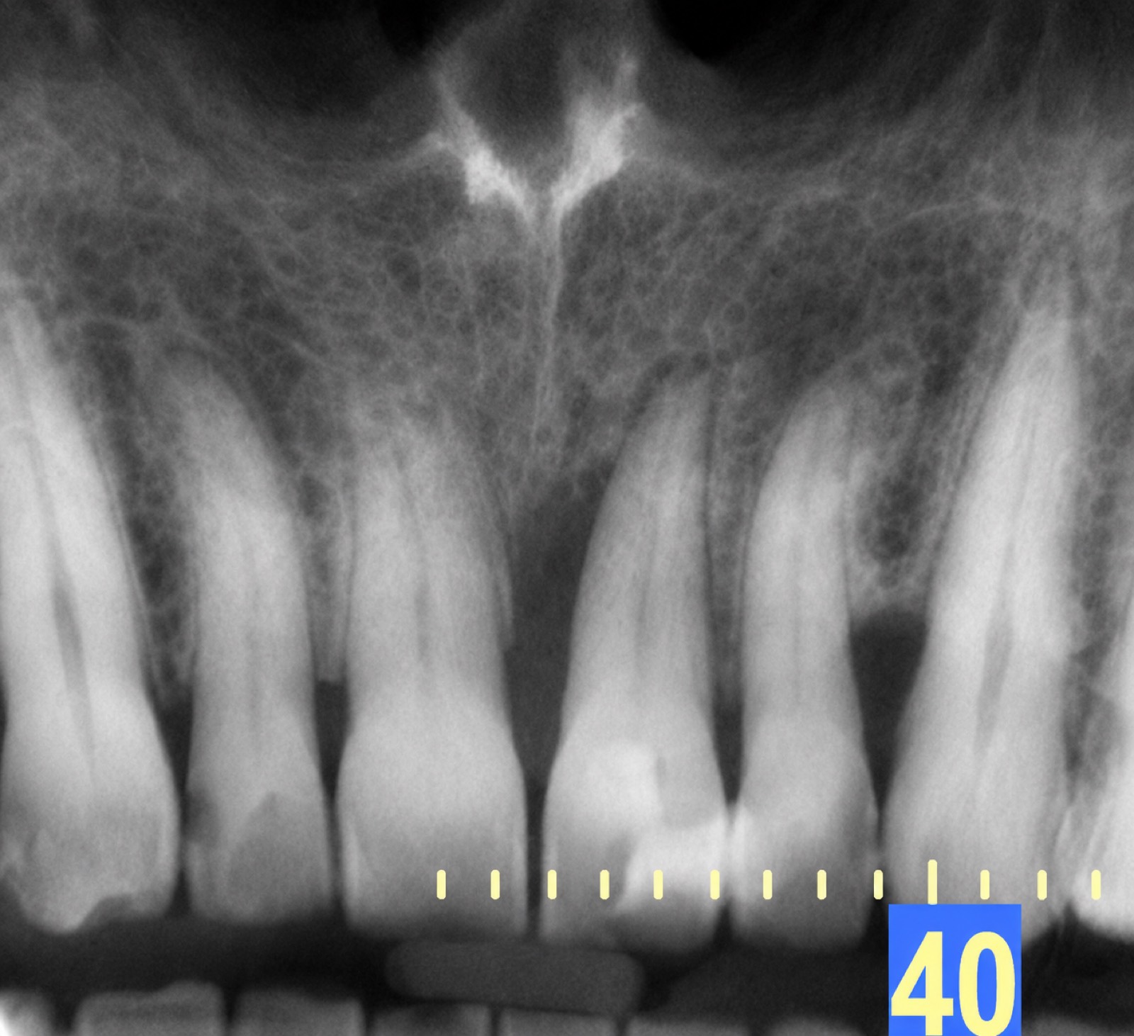 Casos clínicos 23 Regeneración ósea dental, caso 1, antes. Dra. Mercedes Iriarte, Belgrano.