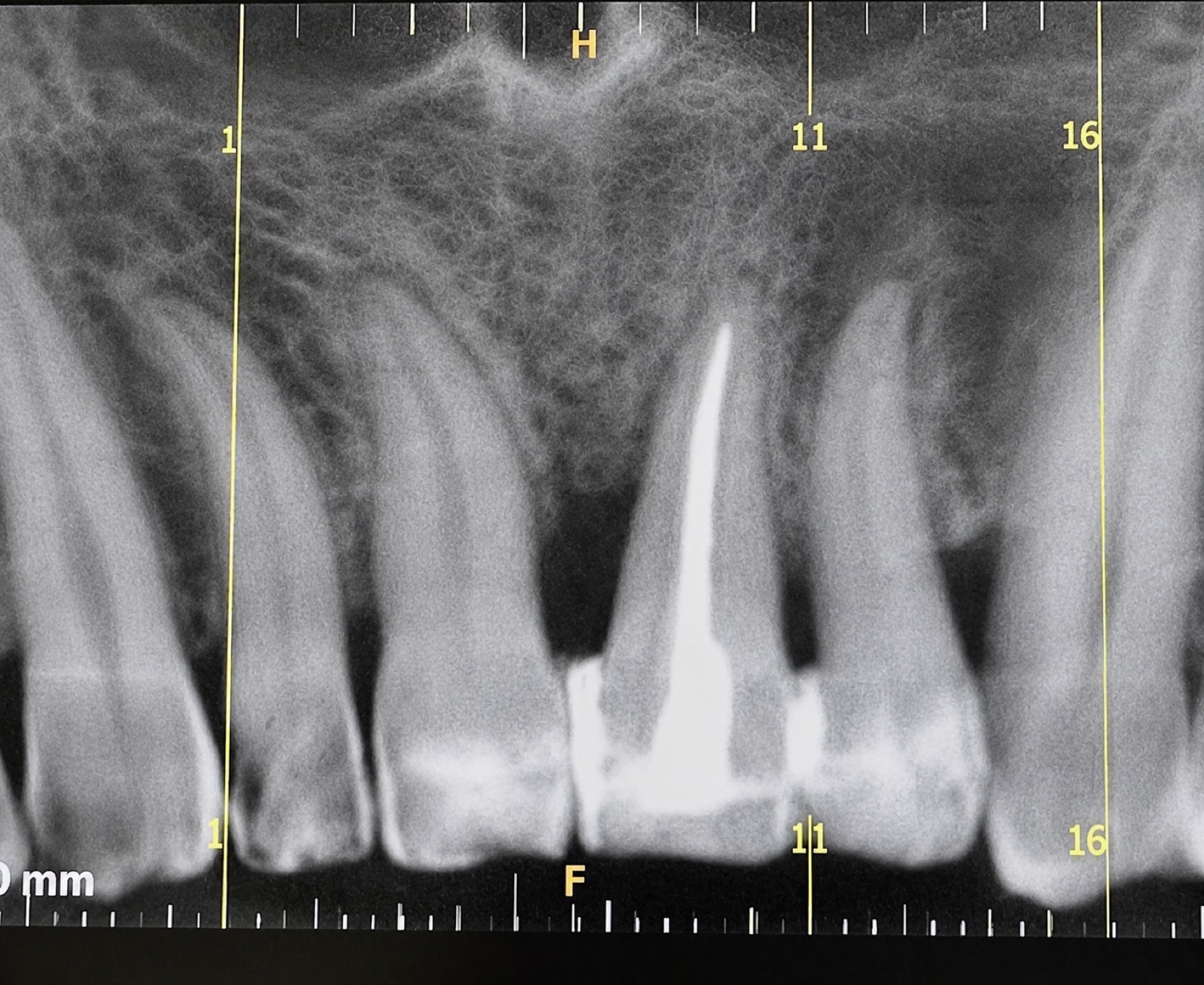 Casos clínicos 24 Regeneración ósea dental, caso 1, después. Dra. Mercedes Iriarte, Belgrano.