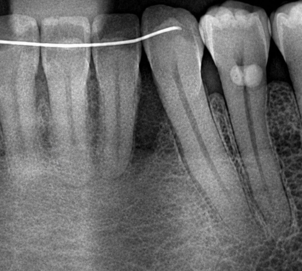 Regeneración ósea dental, caso 2, antes. Dra. Mercedes Iriarte, Belgrano.