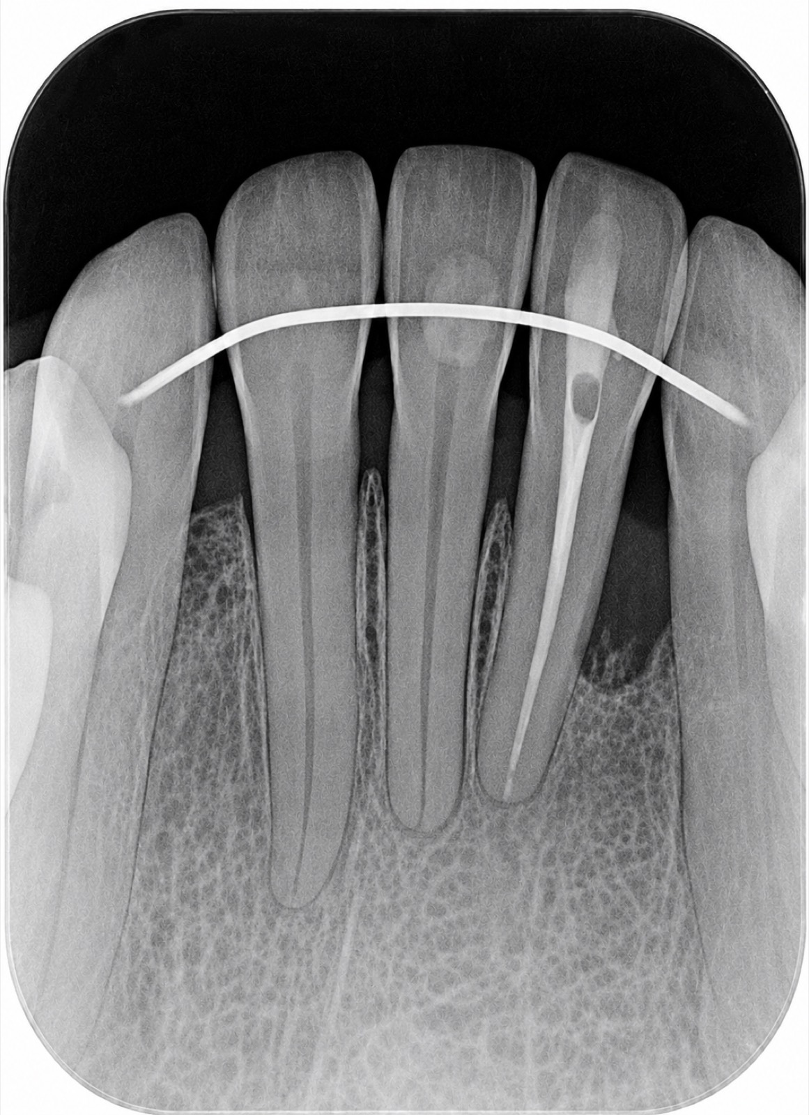 Casos clínicos 26 Regeneración ósea dental, caso 2, después. Dra. Mercedes Iriarte, Belgrano.