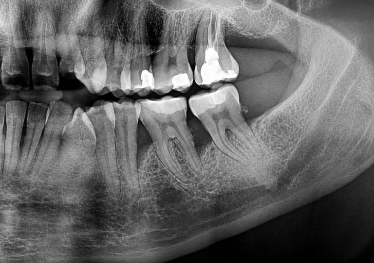 Inicio 4 Regeneración ósea dental, caso 3, antes. Dra. Mercedes Iriarte, Belgrano.