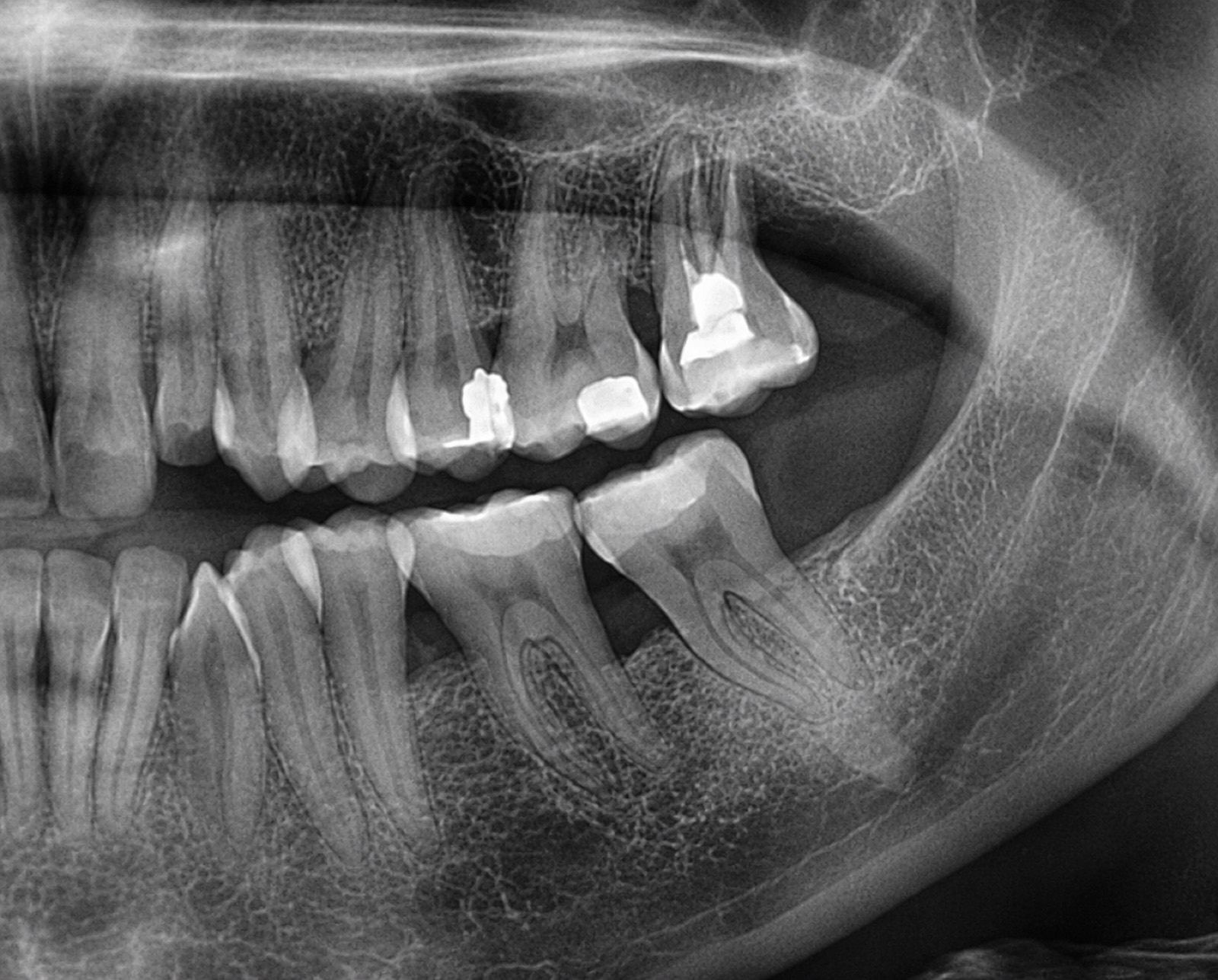 Casos clínicos 28 Regeneración ósea dental, caso 3, después. Dra. Mercedes Iriarte, Belgrano.