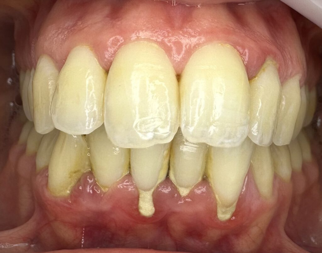Enfermedad periodontal 1 Tratamiento periodontal de encías, caso 1, antes. Dra. Mercedes Iriarte, Belgrano.