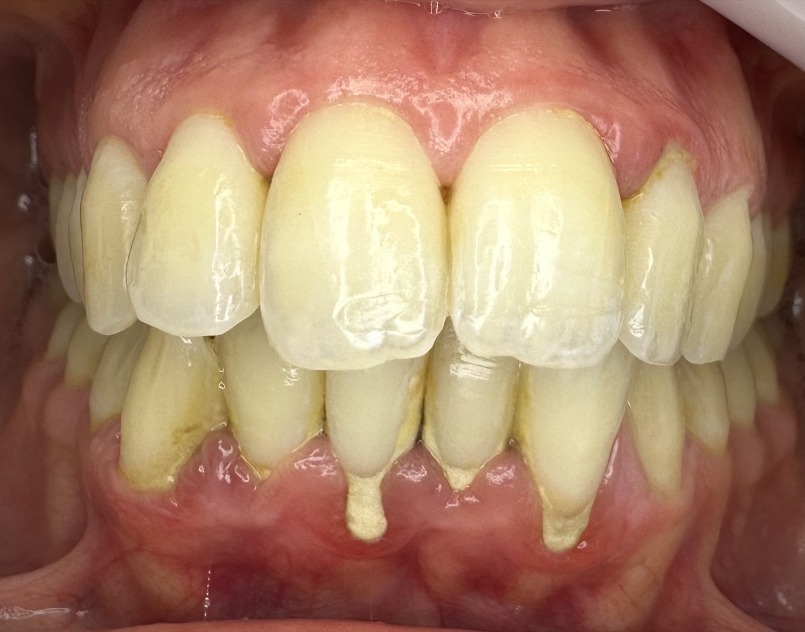 Casos clínicos 1 Tratamiento periodontal de encías, caso 1, antes. Dra. Mercedes Iriarte, Belgrano.