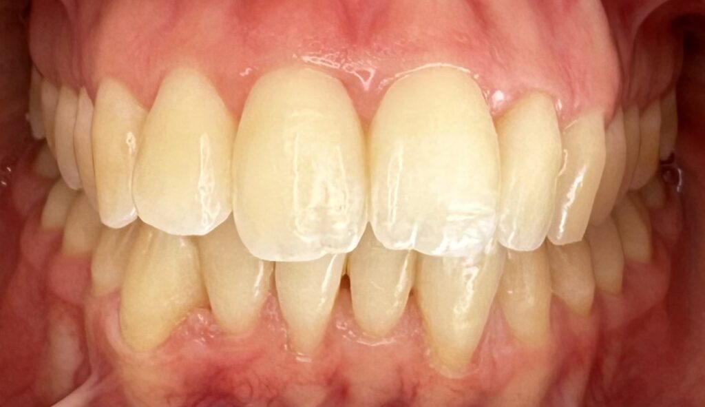 Enfermedad periodontal 2 Tratamiento periodontal de encías, caso 1, después. Dra. Mercedes Iriarte, Belgrano.