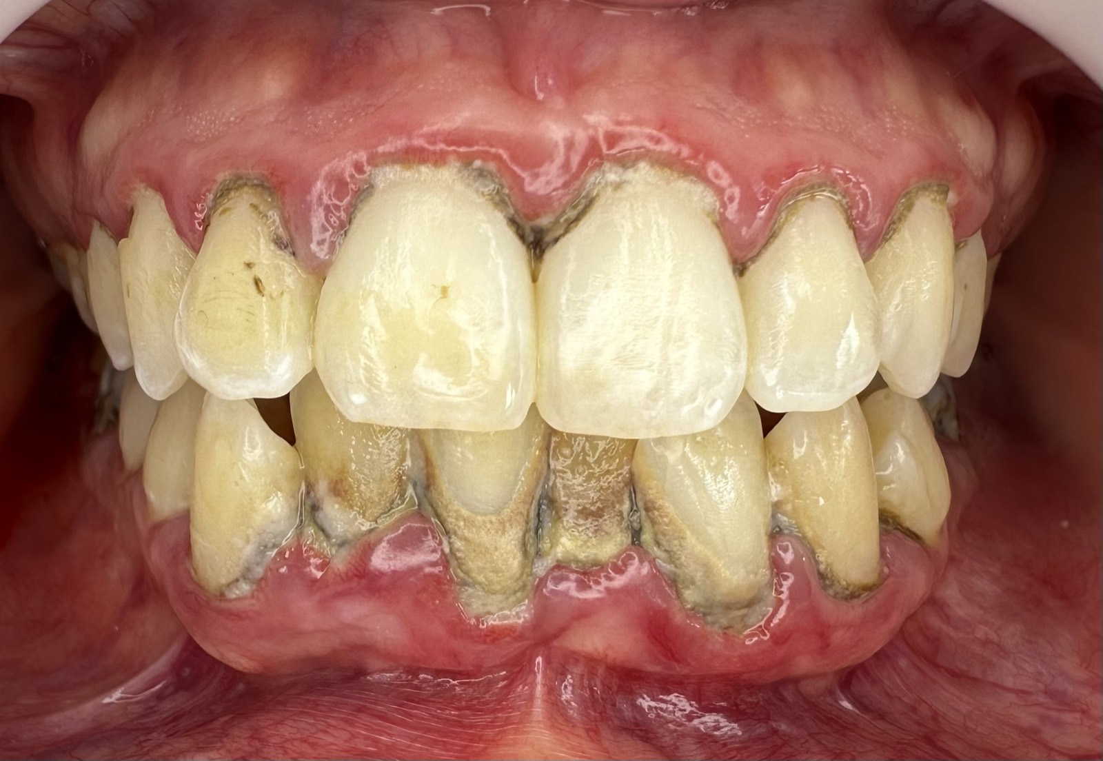 Casos clínicos 3 Tratamiento periodontal de encías, caso 2, antes. Dra. Mercedes Iriarte, Belgrano.