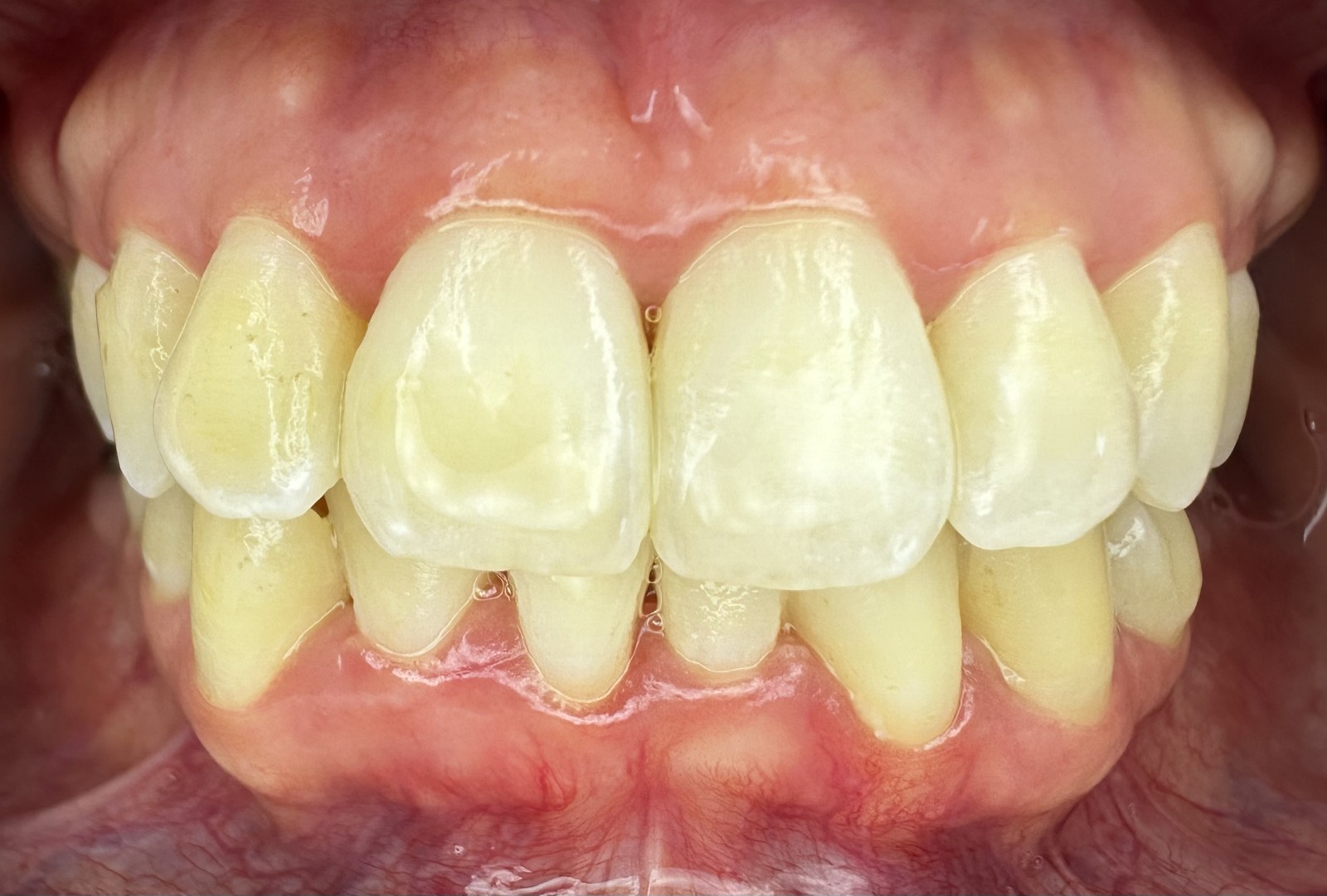 Casos clínicos 4 Tratamiento periodontal de encías, caso 2, después. Dra. Mercedes Iriarte, Belgrano.