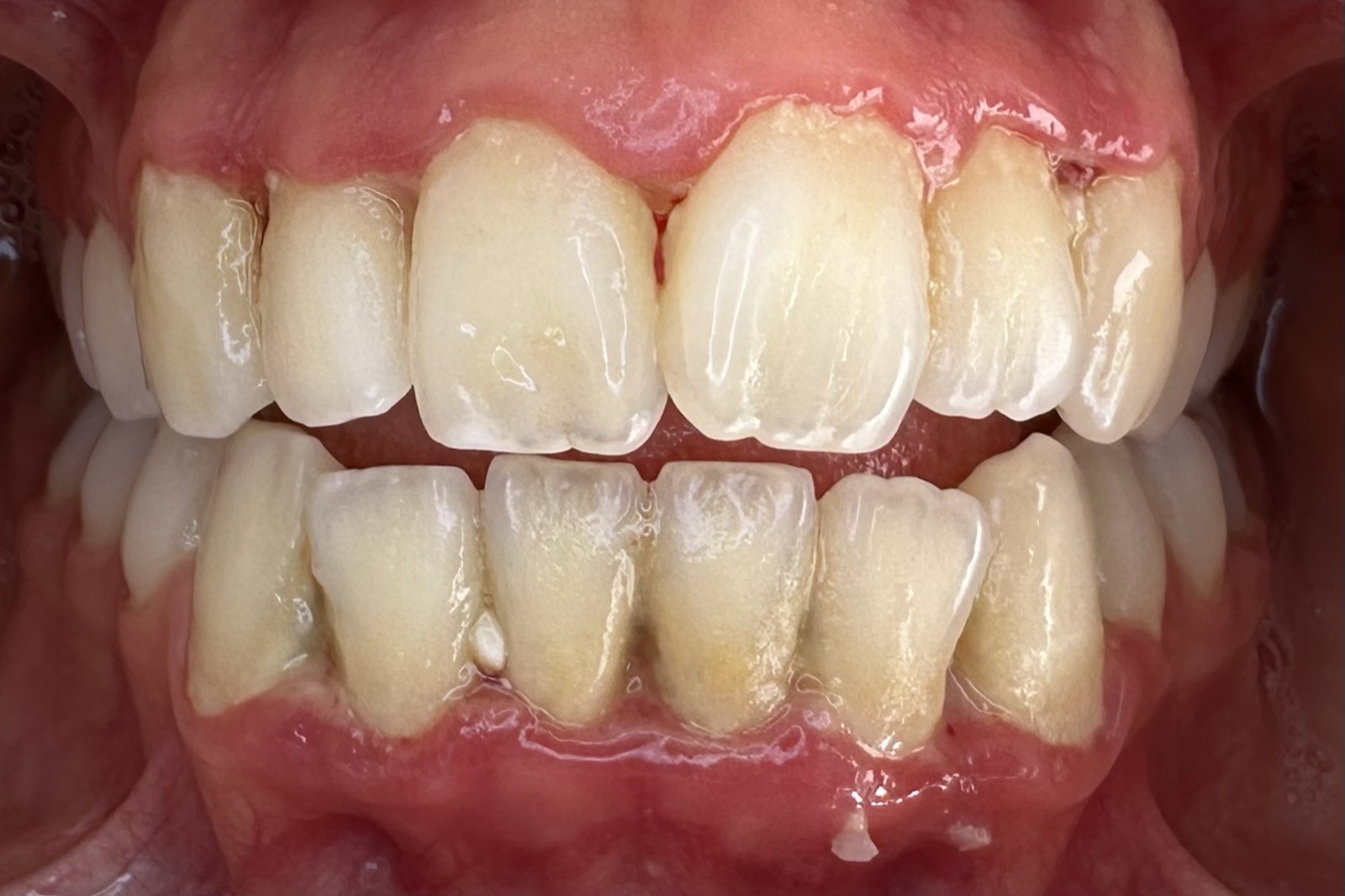 Casos clínicos 5 Tratamiento periodontal de encías, caso 3, antes. Dra. Mercedes Iriarte, Belgrano.