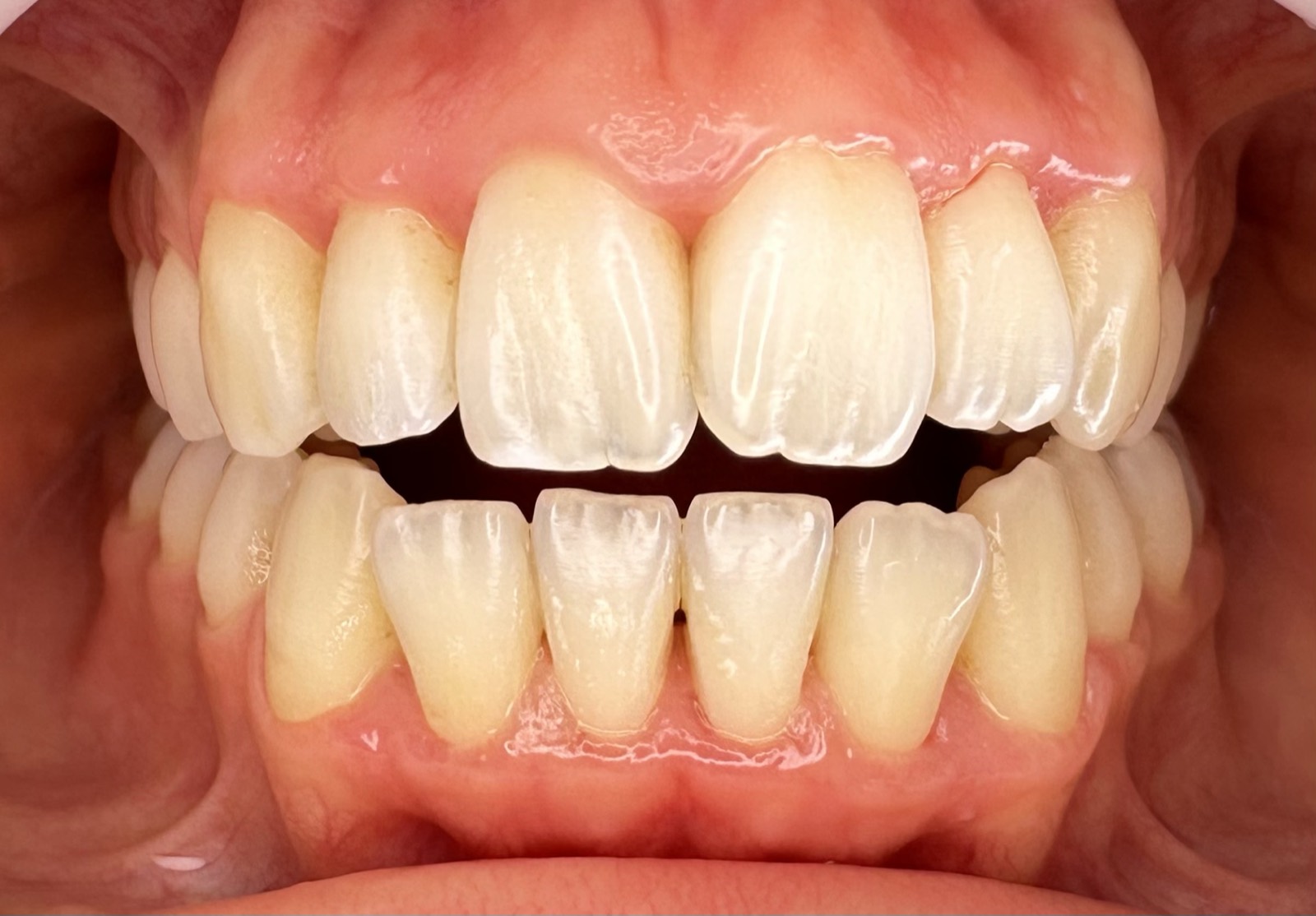 Casos clínicos 6 Tratamiento periodontal de encías, caso 3, después. Dra. Mercedes Iriarte, Belgrano.