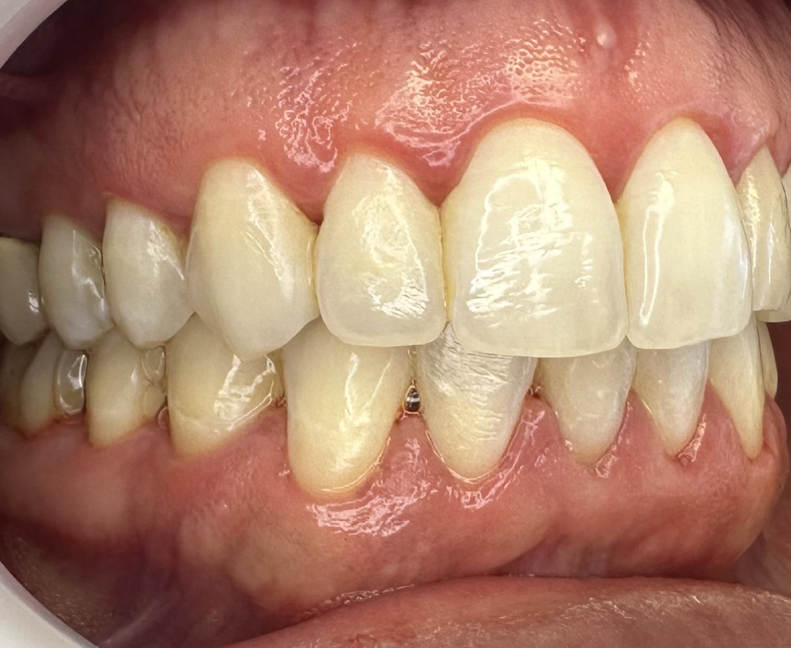 Casos clínicos 9 Tratamiento periodontal de encías, caso 4, antes, vista lateral. Dra. Mercedes Iriarte, Belgrano.