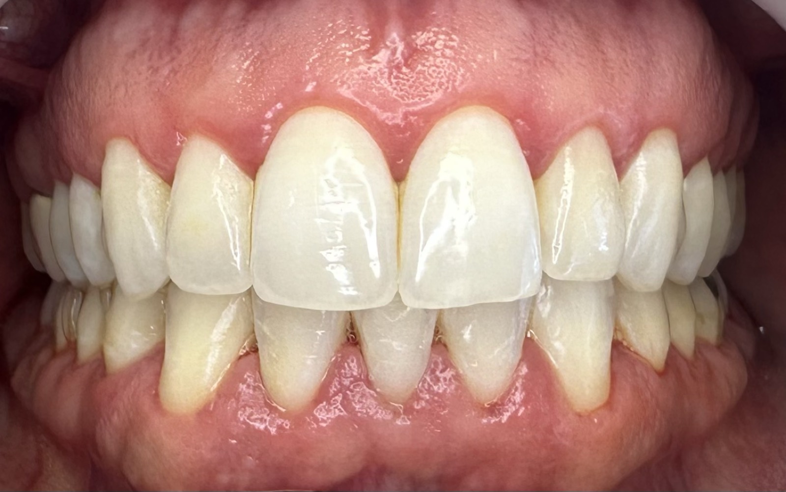 Casos clínicos 7 Tratamiento periodontal de encías, caso 4, antes. Dra. Mercedes Iriarte, Belgrano.