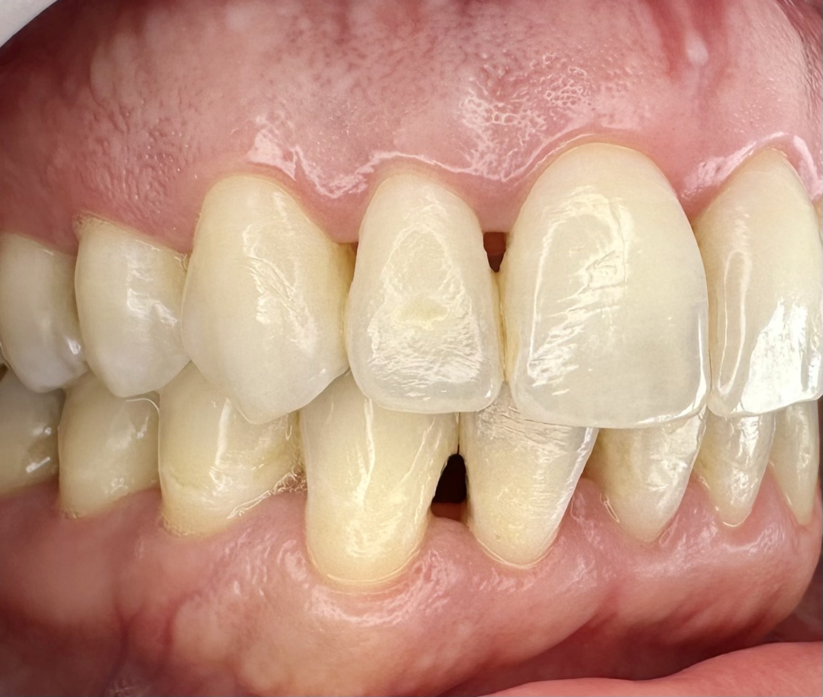 Casos clínicos 10 Tratamiento periodontal de encías, caso 4, después, vista lateral. Dra. Mercedes Iriarte, Belgrano.