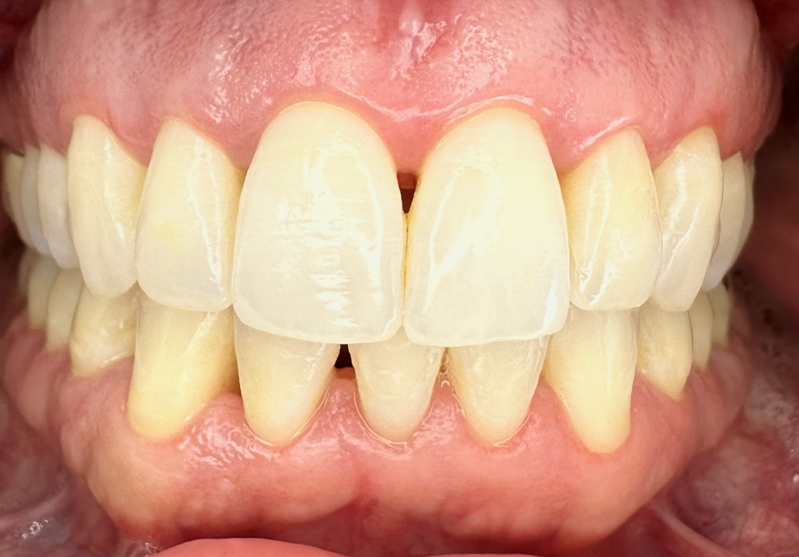 Casos clínicos 8 Tratamiento periodontal de encías, caso 4, después. Dra. Mercedes Iriarte, Belgrano.