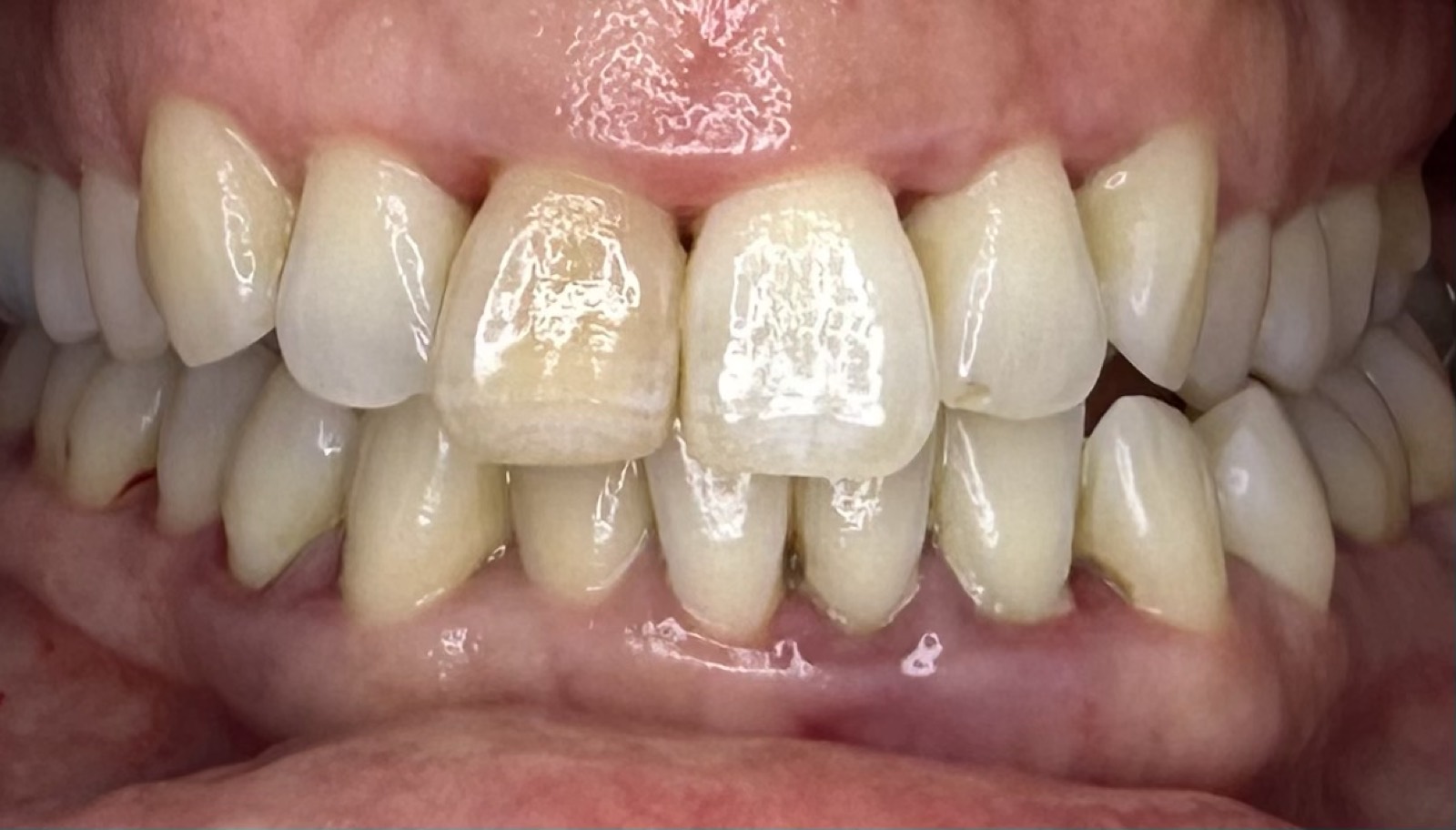 Casos clínicos 11 Tratamiento periodontal de encías, caso 5, antes. Dra. Mercedes Iriarte, Belgrano.