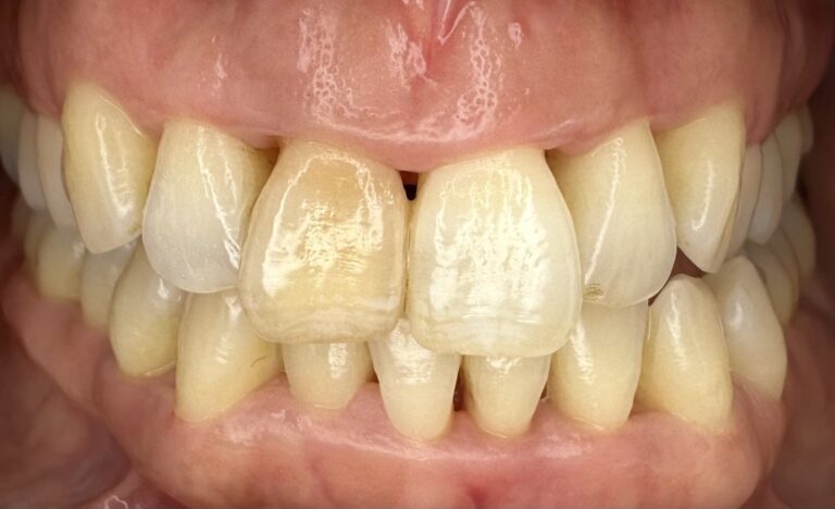Inicio 3 Tratamiento periodontal de encías, caso 5, después. Dra. Mercedes Iriarte, Belgrano.