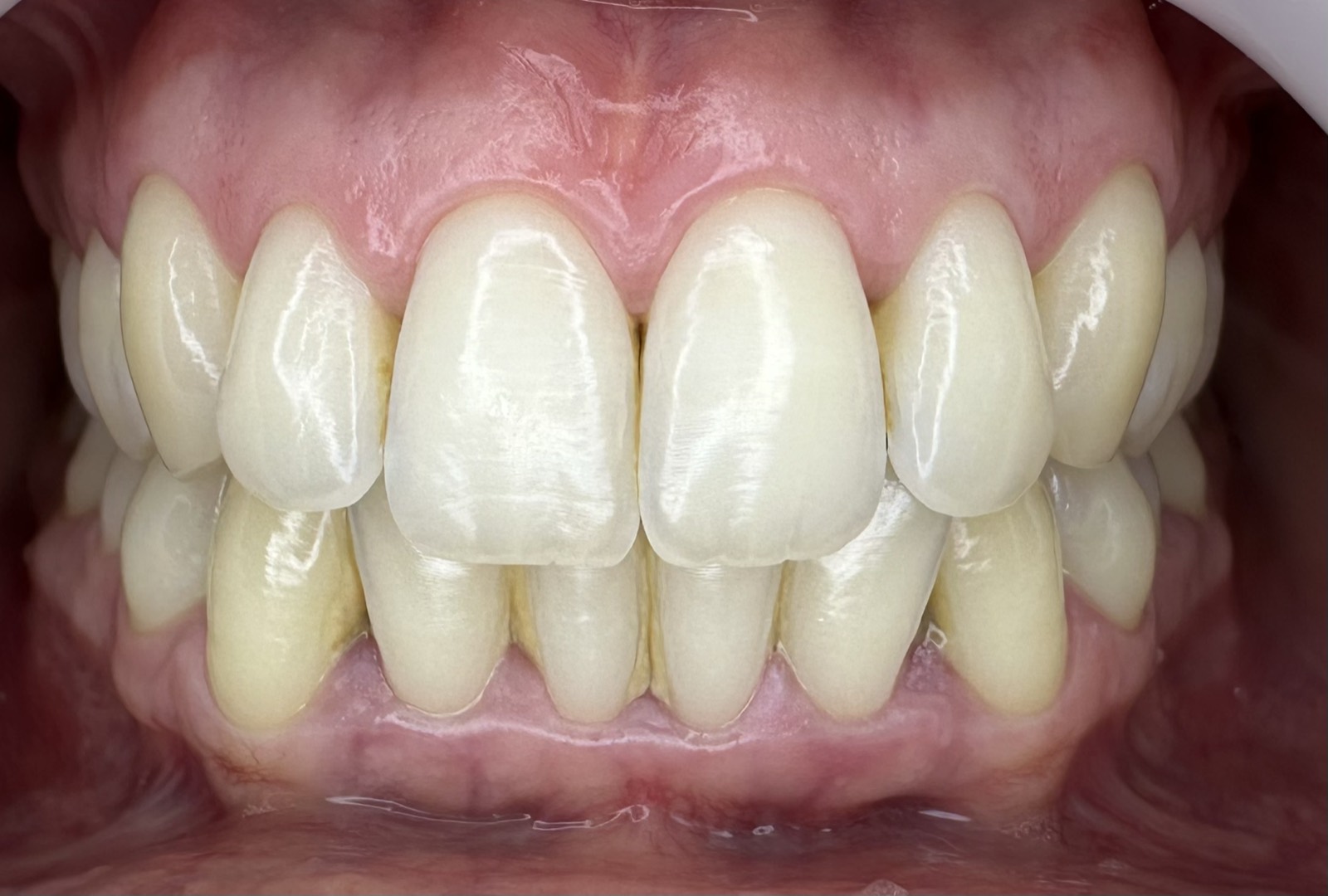 Casos clínicos 13 Tratamiento periodontal de encías, caso 6, antes. Dra. Mercedes Iriarte, Belgrano.