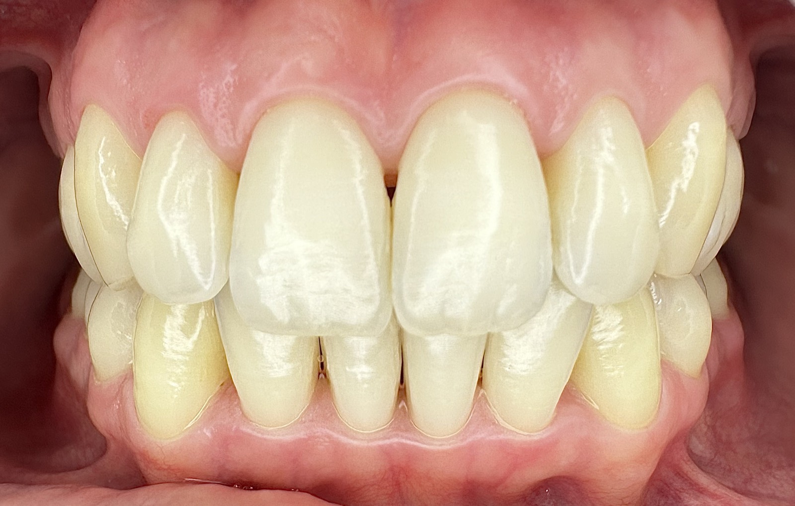 Casos clínicos 14 Tratamiento periodontal de encías, caso 6, después. Dra. Mercedes Iriarte, Belgrano.